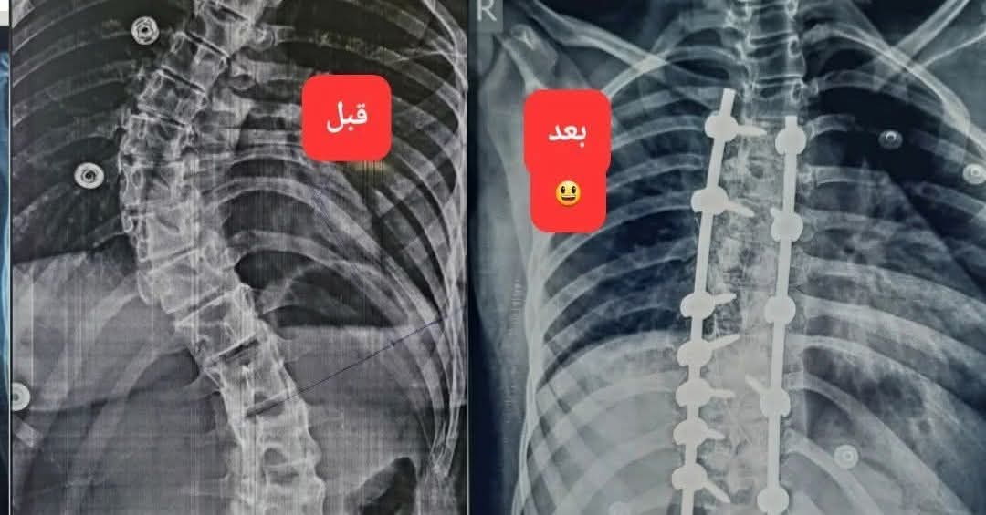 لأول مرة في عدن.. إجراء عملية جراحية متقدمة لتصحيح تشوه واعوجاج العمود الفقري بنجاح